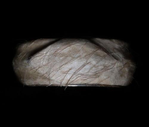  A Gold Ring Covered in Human Skin