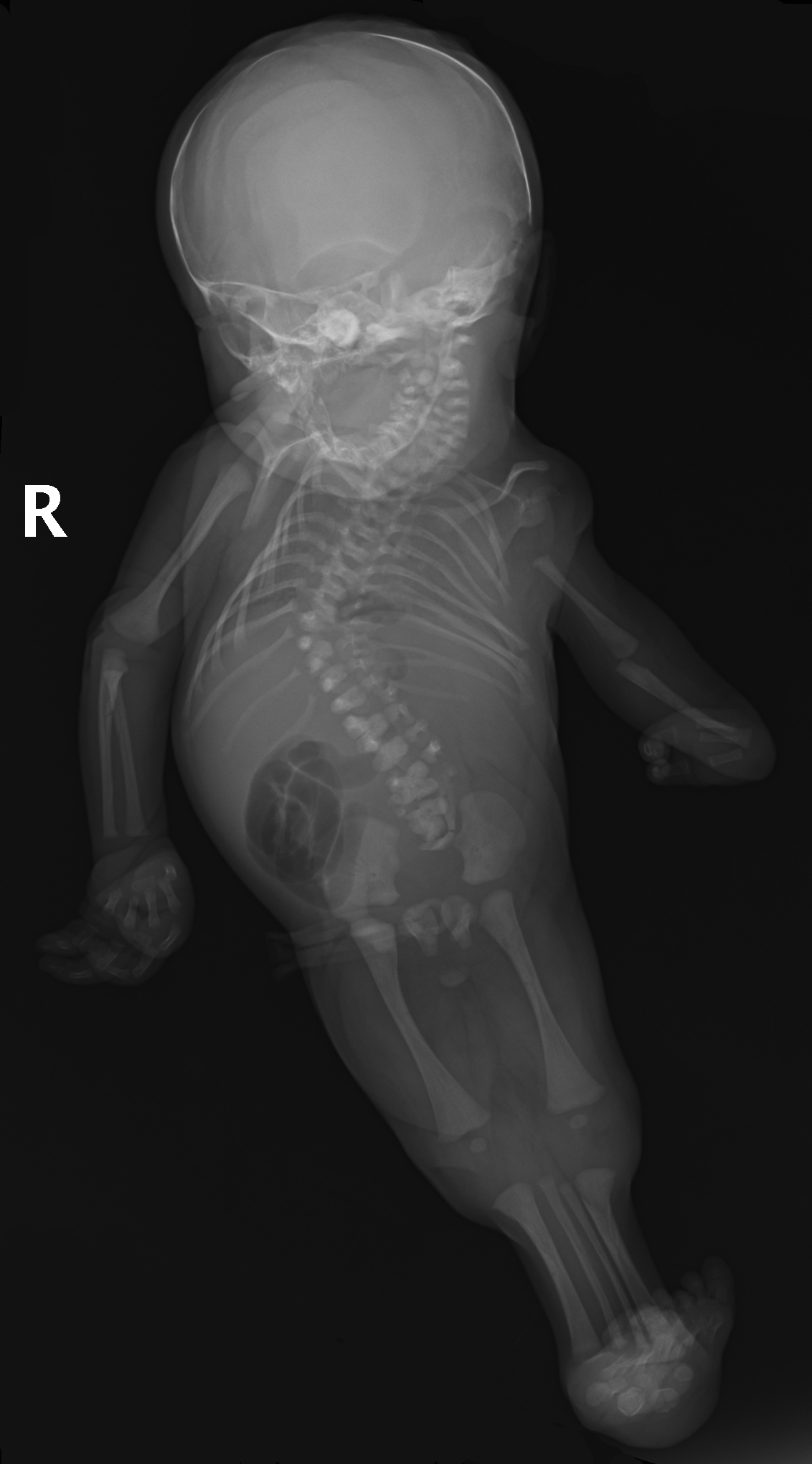 Mermaid Syndrome via radiopaedia.org