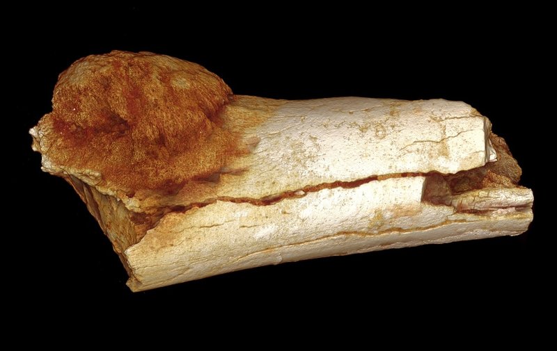 Scientists using a high-resolution X-ray technique found that this bone belonging to a hominin, an ancient, extinct relative of modern humans, has a malignant tumor. Patrick Randolph-Quinney (UCLan)